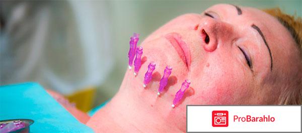 Мезонити отзывы негативные 