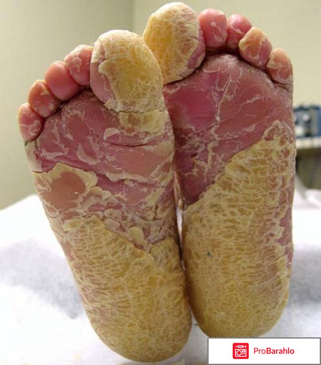 Тинедол крем от грибка 