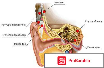 Кохлеарная имплантация 