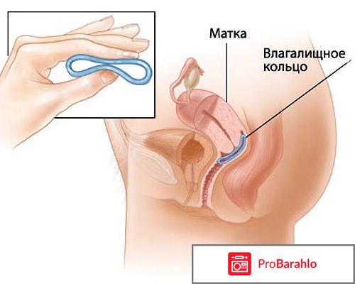Вагинальное кольцо 