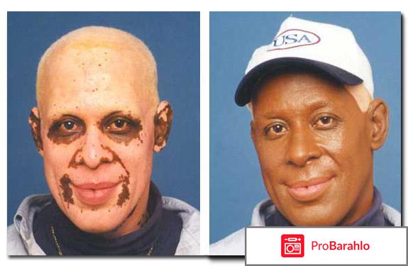 Как у меня получилось вылечить витилиго отрицательные отзывы