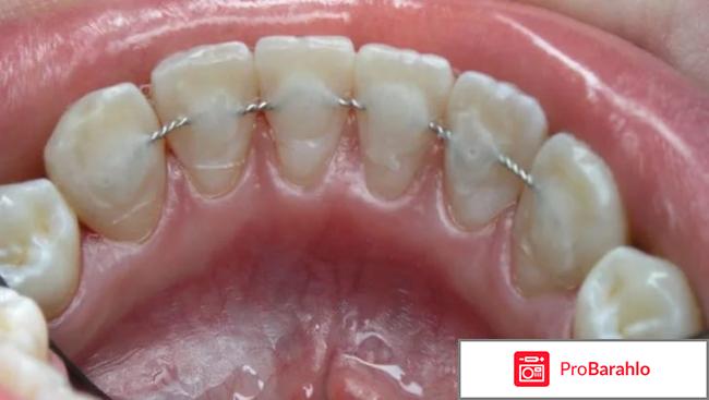 Шинирование зубов отзывы пациентов обман