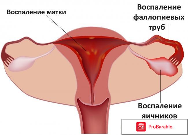 Сальпингит обман