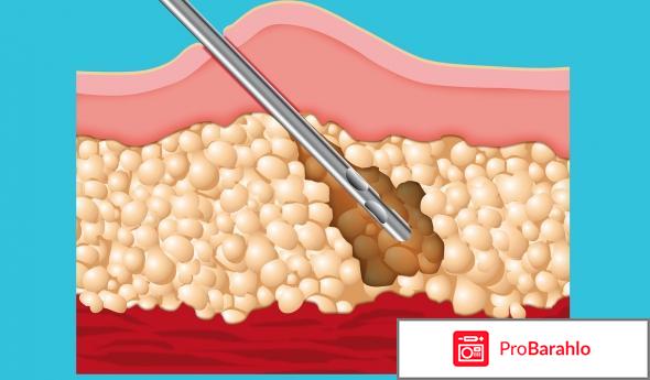 Липосакция живота отзывы отрицательные отзывы