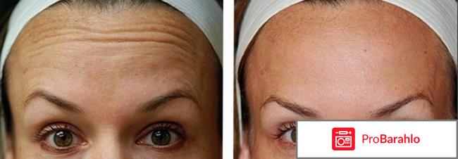 Диспорт для инъекций в аптеке цена обман