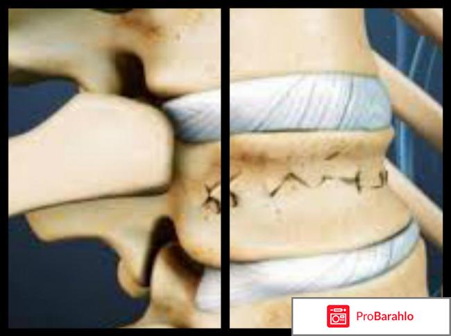 Остерепар инструкция по применению цена отзывы обман