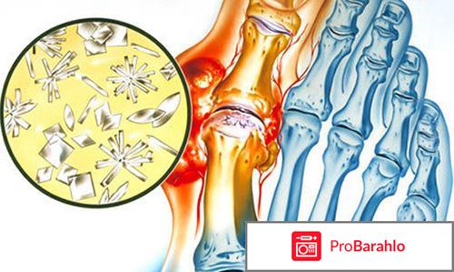 Как избавиться от мочевой кислоты в суставах отрицательные отзывы