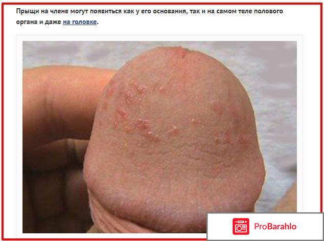 Прыщи на половом члене обман