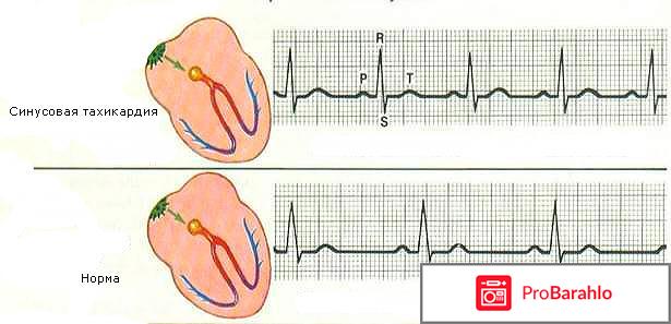 Приступ тахикардии симптомы отзывы владельцев