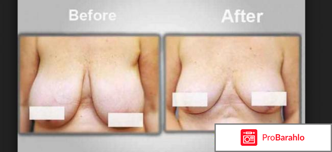 Операция по уменьшению груди 