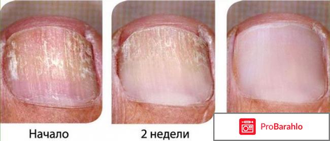 Экзодерил раствор отзывы обман