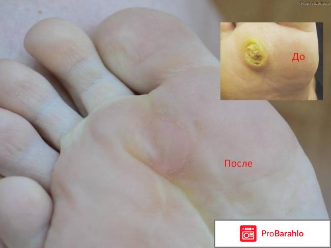 Папилайт это развод или правда? 