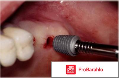 Зубные импланты отзывы пациентов отрицательные отрицательные отзывы