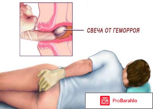 Свечи проктозан цена 