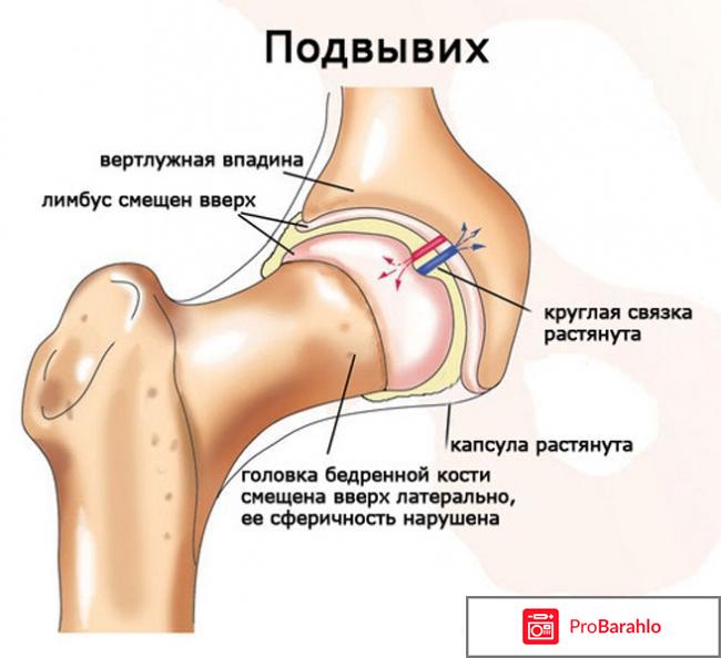 Отзывы о плазмолифтинге тазобедренного сустава отрицательные отзывы