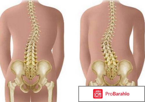 Чем опасен спондилез отрицательные отзывы