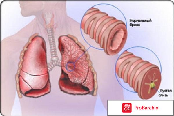 Препараты расширяющие бронхи отрицательные отзывы