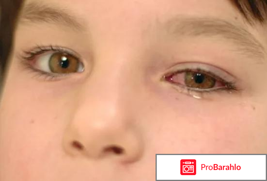 Офтальмоферон отзывы обман