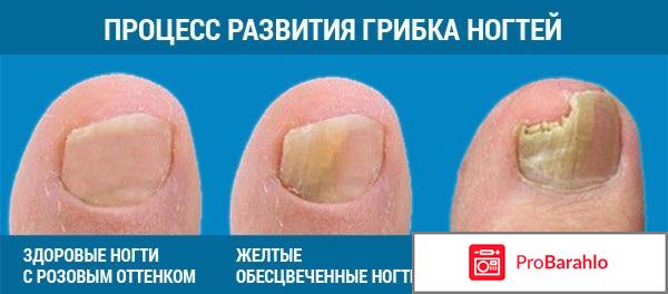 Офламилак от грибка ногтей 