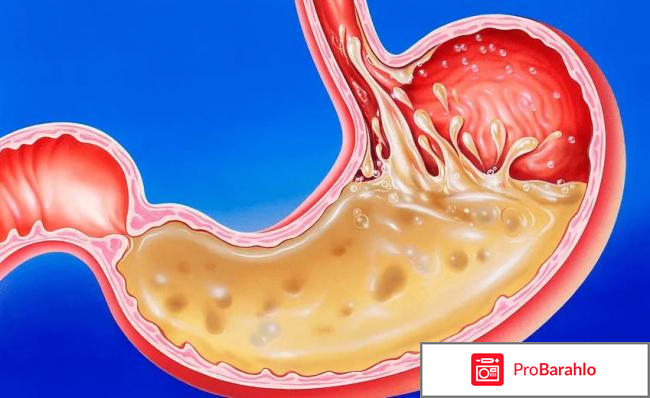 Гастрит с повышенной и пониженной кислотностью как отличить отрицательные отзывы