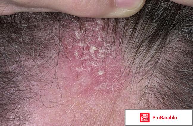 Себорейные корочки 