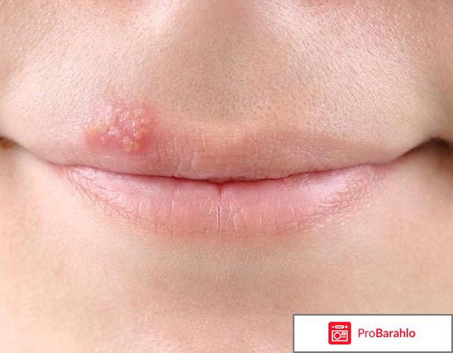 Герпес лечение народными средствами 