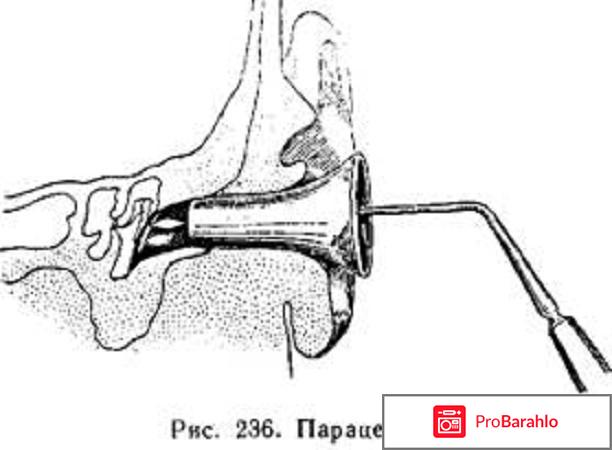 Парацентез барабанной перепонки 