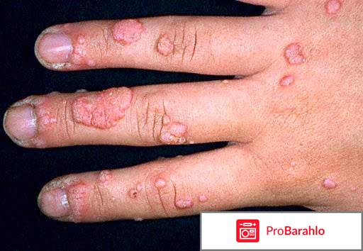 Лечение впч у женщин препараты отзывы 