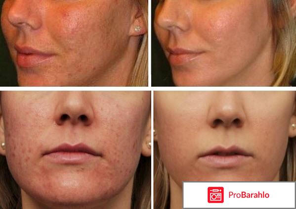 Желтый пилинг отзывы форум косметологов 