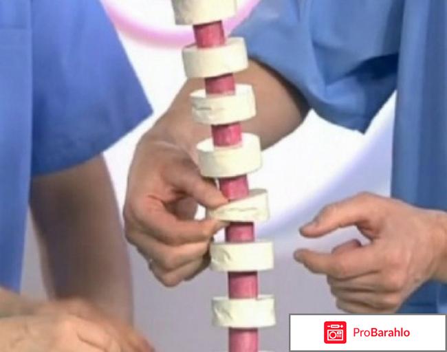 Болезнь шойерман-мау что это обман