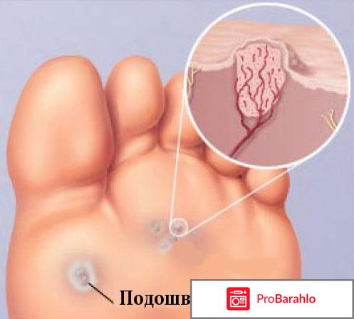 Бородавки на ногах: причины и методы удаления обман