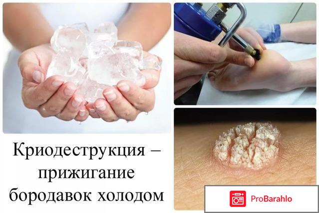 Удаление папиллом жидким азотом последствия отрицательные отзывы
