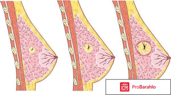 Мастопатия молочной железы: причины, симптомы, виды обман