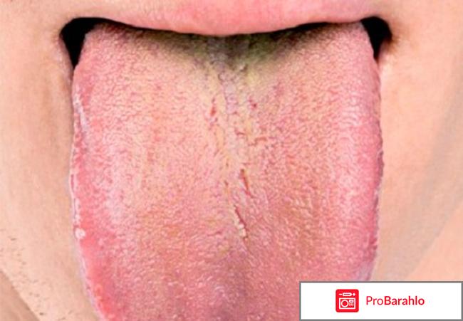 Налет на языке: причины, фото 