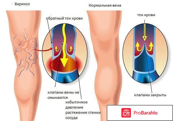 Варикоз форум отрицательные отзывы